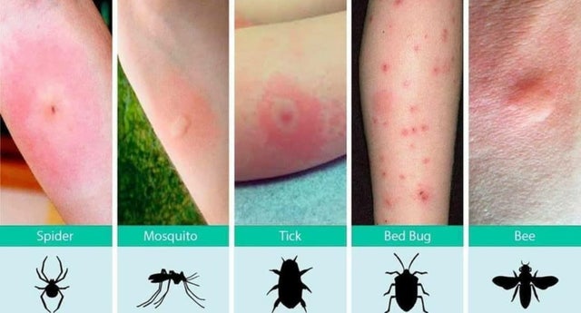 bug bite chart, types of bug bites chart, infographics, cool infographics, interesting inforgraphics, cool guides cool charts, interesting guides, interesting guide, cool guide random guides, random cool guides, random interesting guides, cool charts, interesting charts, random charts, informative charts, cool chart, interesting chart, random chart