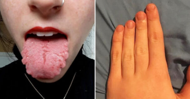 bizarre photos - geographic tongue - staircase fingers