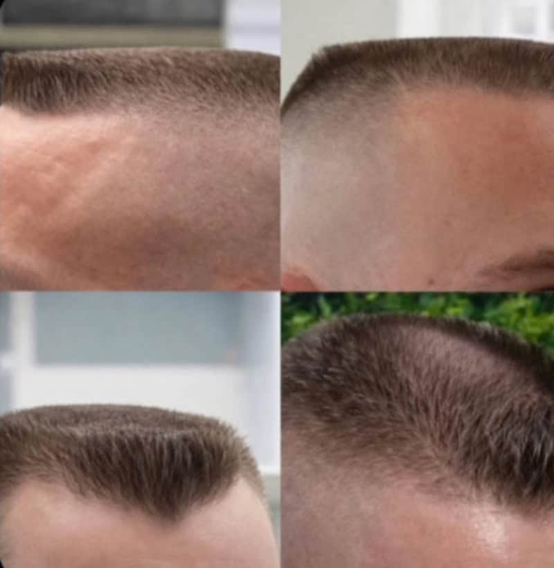Comparison of hairlines before and after haircut fails.