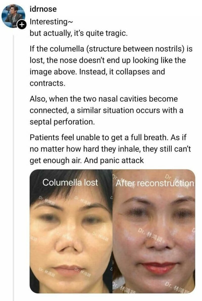 Before and after nasal reconstruction showing columella loss and repair.