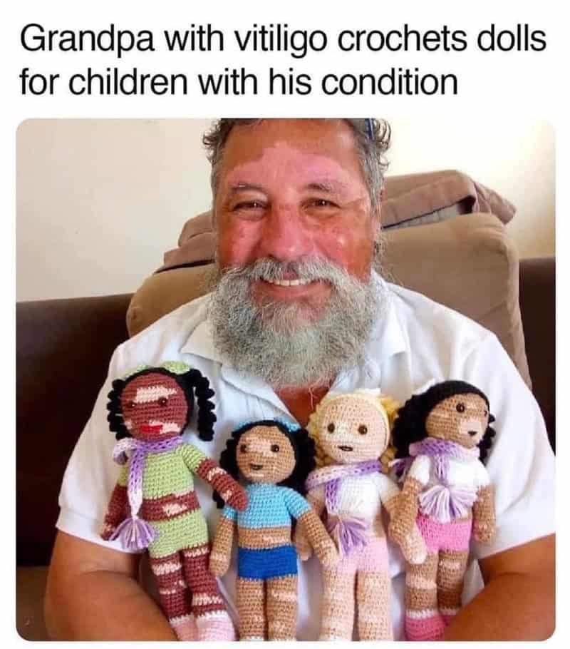 Grandpa with vitiligo crochets dolls for children with his condition.