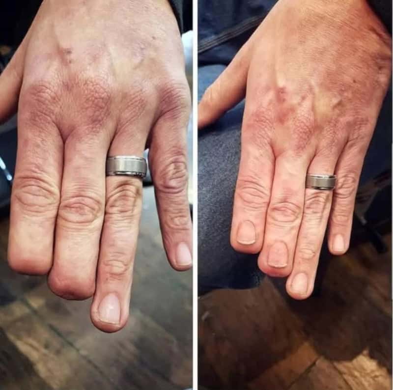Comparison of a hand before and after skin treatment, showing improved skin texture.