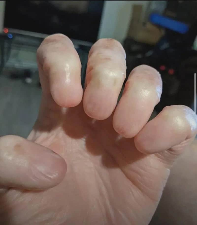 Close-up of a hand with swollen, discolored fingers, some with yellowish nails.