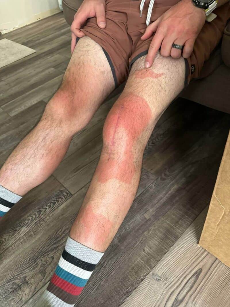 Person with red, irritated, and swollen skin on legs, sitting on floor.