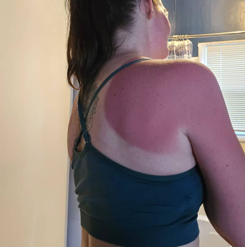Woman with a large red sunburn on her shoulder and upper arm.