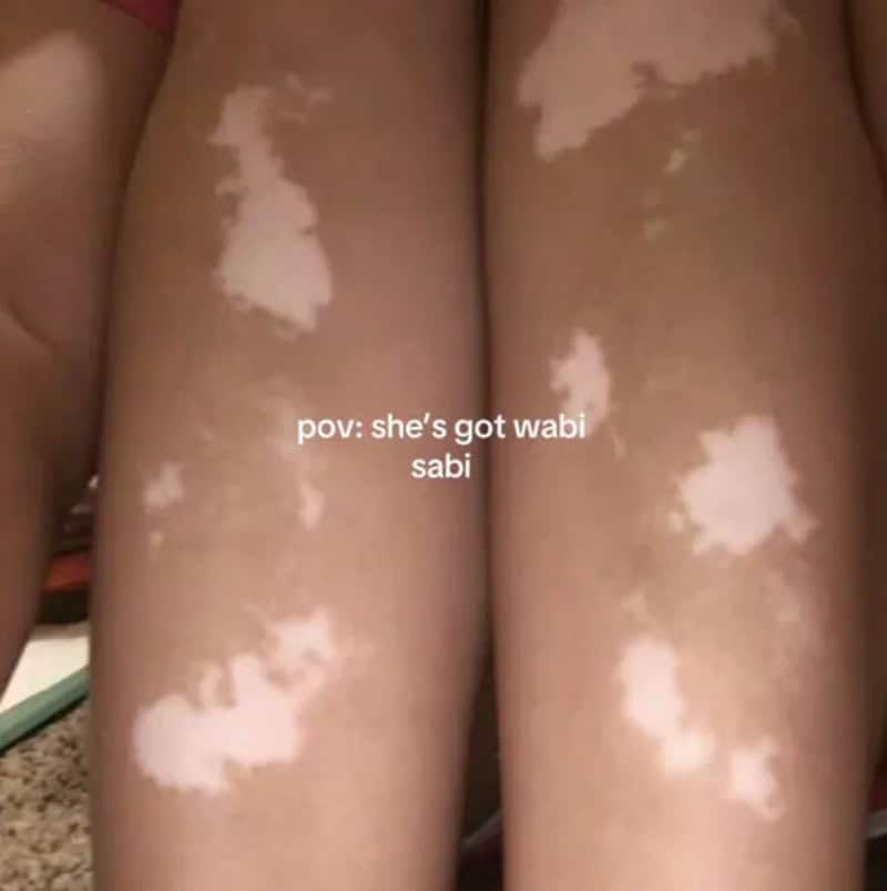 Close-up of legs with vitiligo patches, with text 'pov: she's got wabi sabi'.