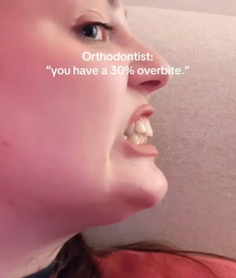 Close-up of a person's face with a humorous expression, showing teeth and a 30% overbite.