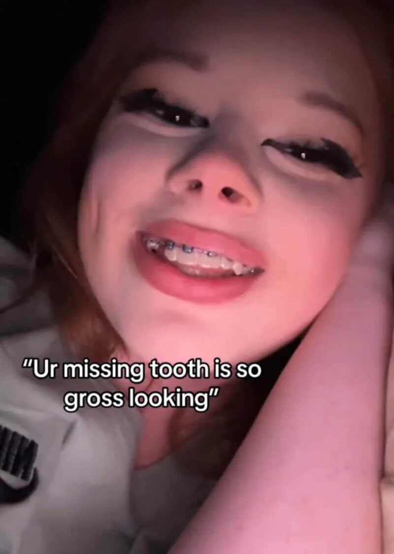 Girl with missing tooth, smiling, with caption 'Ur missing tooth is so gross looking'.