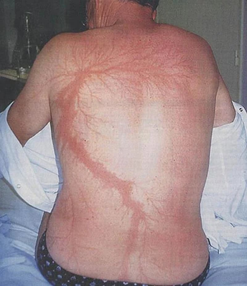 Back of a person with prominent, large, red, vein-like skin markings.