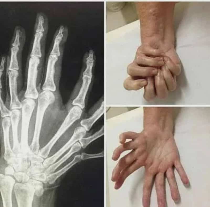 X-ray of a hand and two photos of a hand with abnormal finger growth.