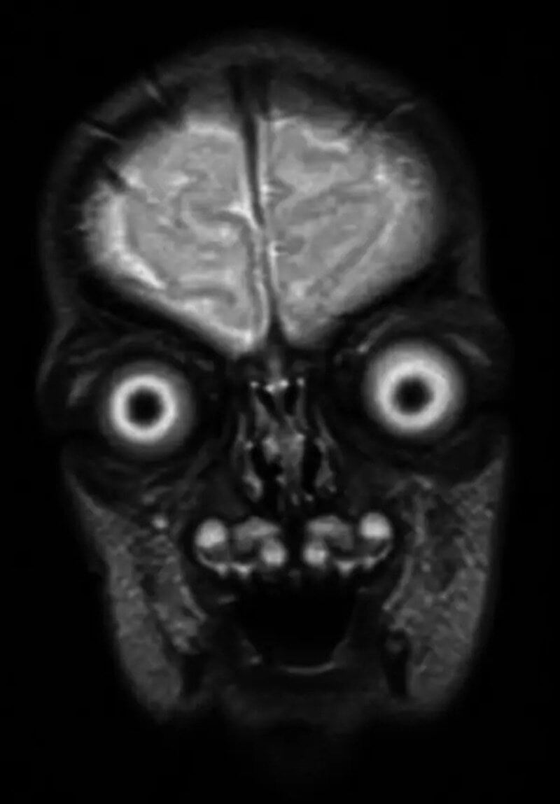 Eerie MRI scan of a brain with glowing eyes and a terrifying face.