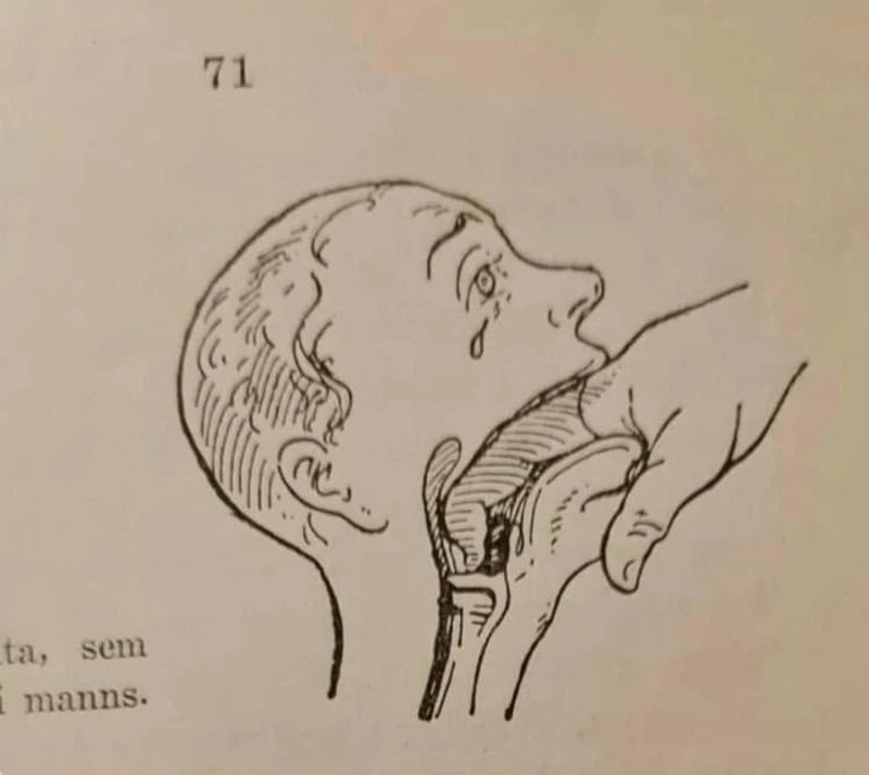 Child with tear in eye having throat examined by a hand, vintage medical illustration.