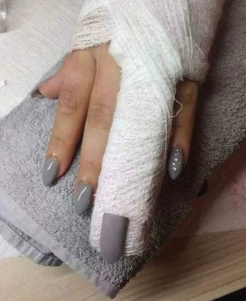 Hand with gray nails and bandaged fingers resting on a towel.