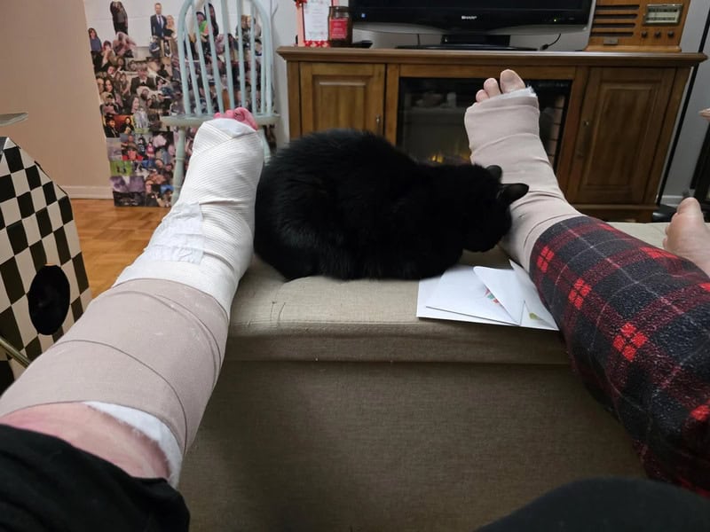 A black cat sleeping between two people's bandaged legs on a couch.