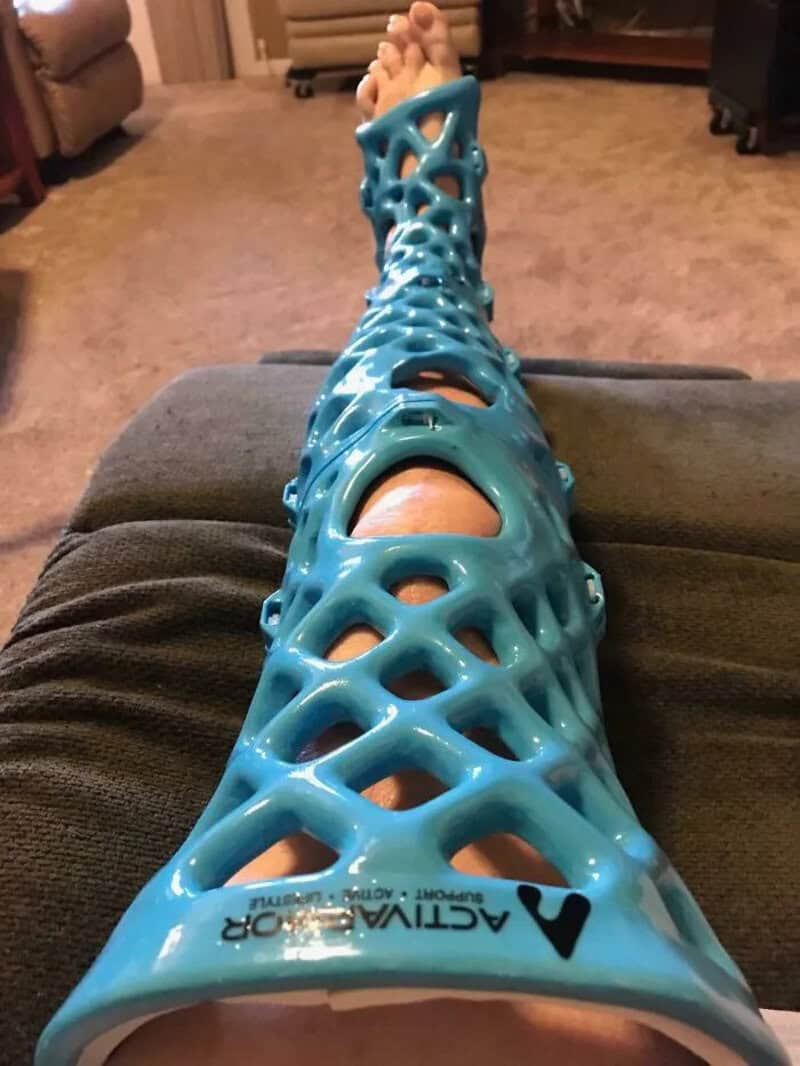 Blue 3D printed leg brace on a person's leg, with a lattice design.