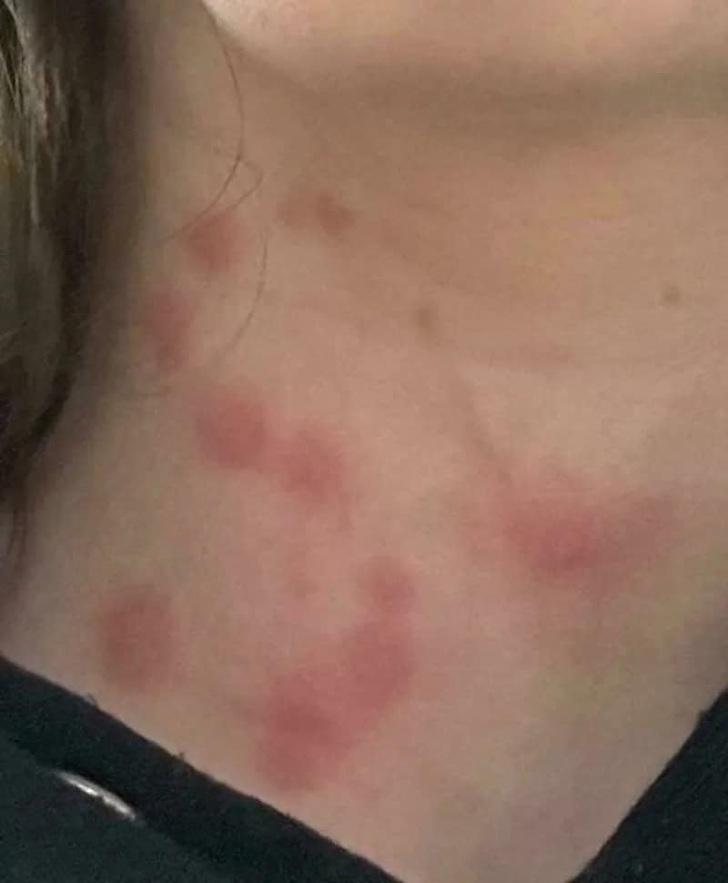 Red skin rash on neck with multiple inflamed patches.