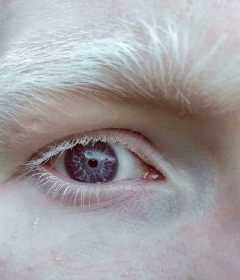 Close-up of a person's eye with a unique blue iris pattern.