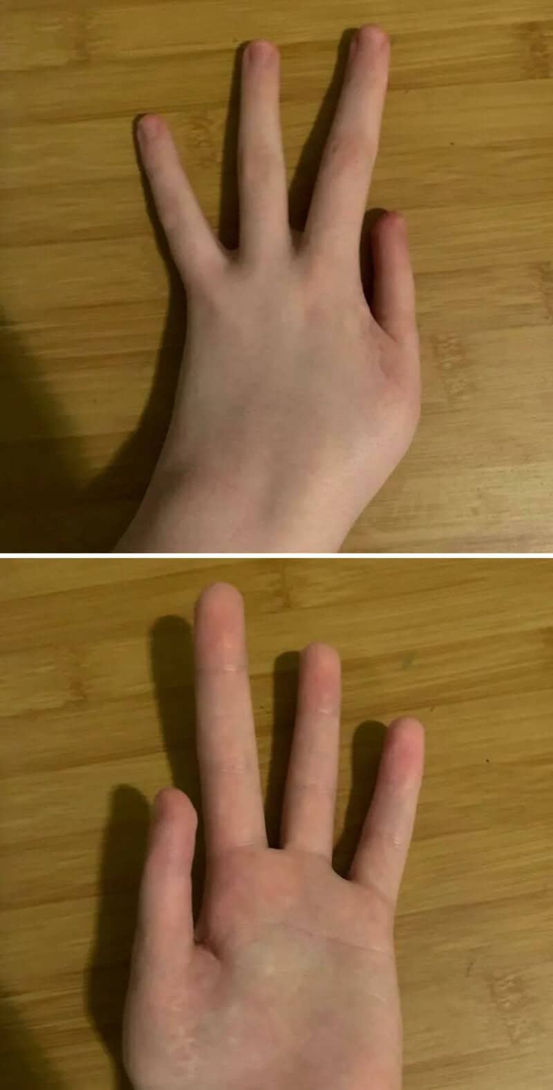 A hand with three fingers on each hand, unusual body feature.