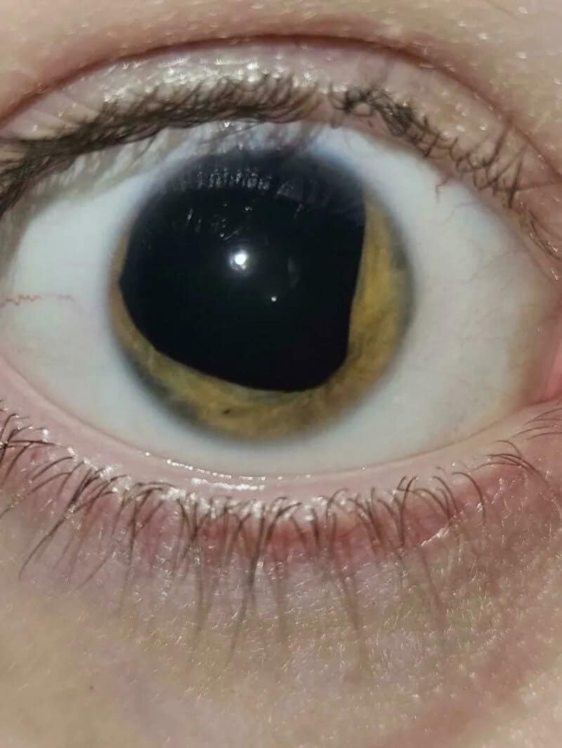 Close-up of a human eye with a unique dark ring around the iris.