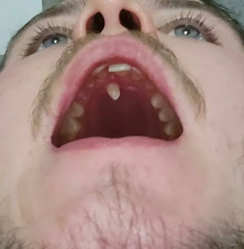 Close-up of a person's open mouth showing extra teeth and unusual features.