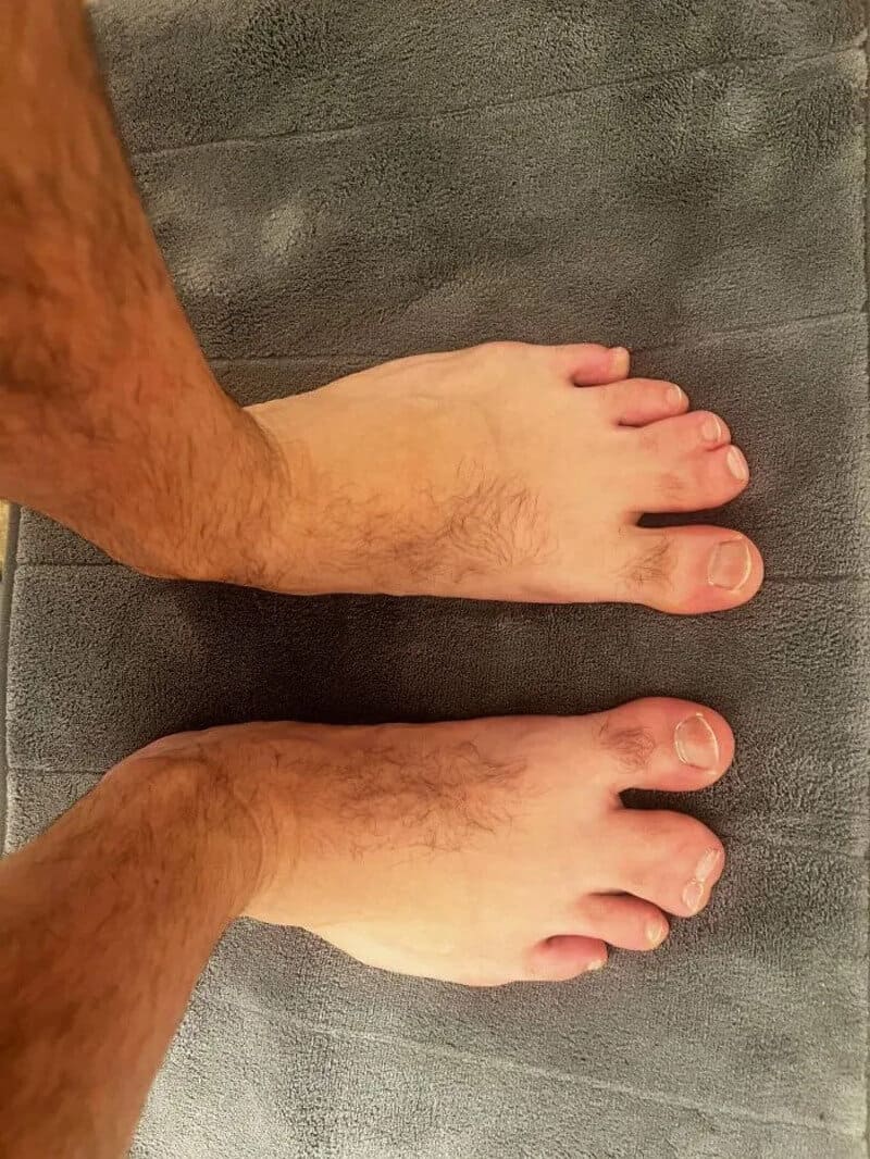 Two feet with toes, one with a normal toe count, the other with an extra toe.