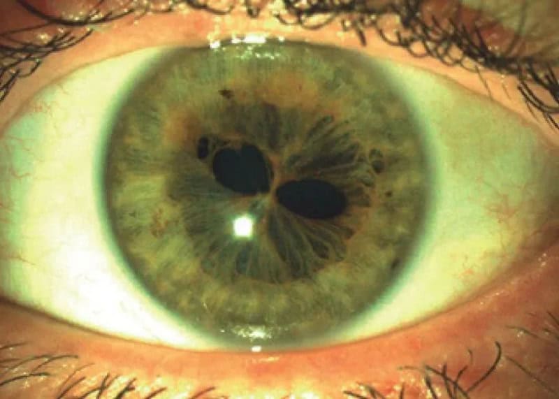 Close-up of a green eye with unusual dark patches in the iris.