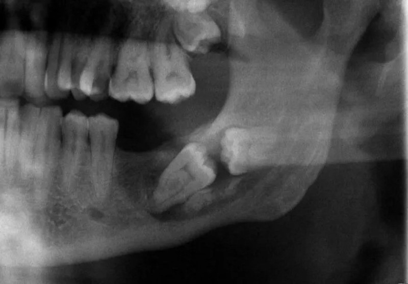 X-ray of a mouth showing impacted wisdom tooth and dental structure.
