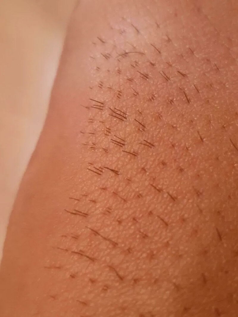 Close-up of skin with numerous small, dark hair stubs and some longer hairs.