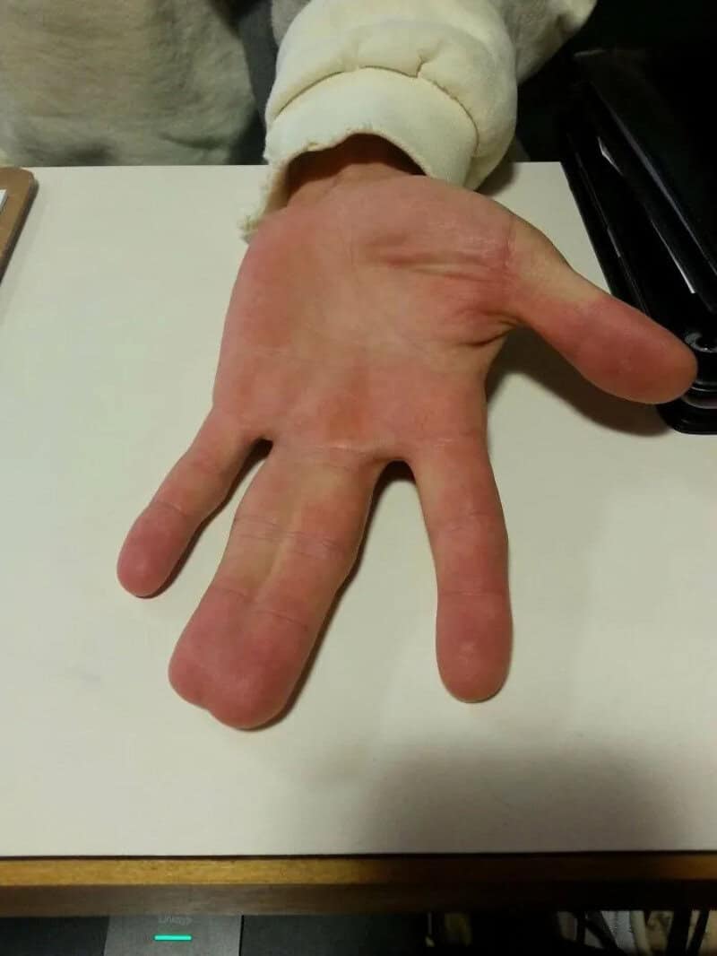 Close-up of a hand with an extra finger, showing unusual finger structure.