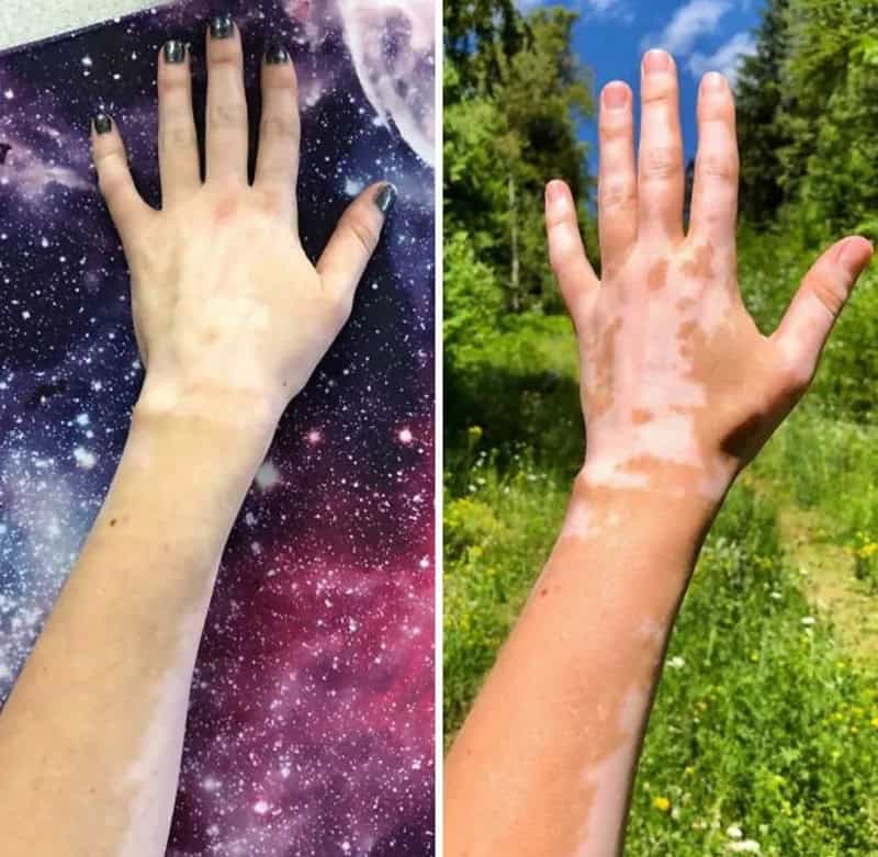 Two hands with vitiligo, one on a galaxy background, one outdoors in nature.