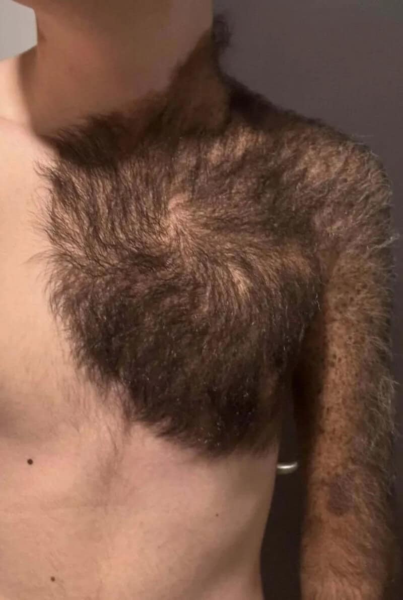 Person with a large patch of hair on the shoulder and arm.