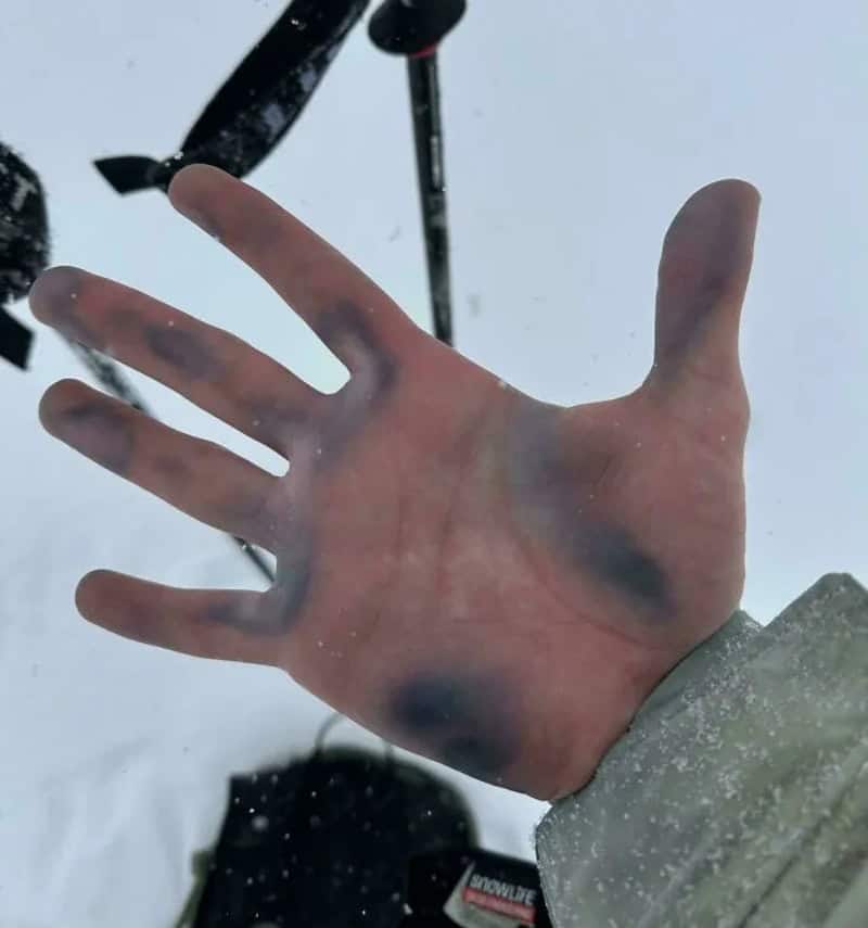 Close-up of a hand with black spots and a bruise, snow and ski equipment in background.