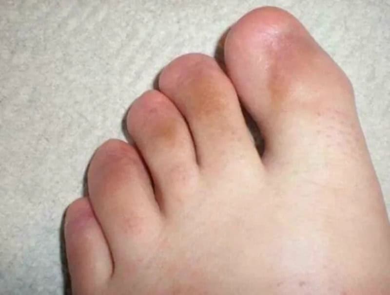 Close-up of a foot with a large bunion on the big toe.