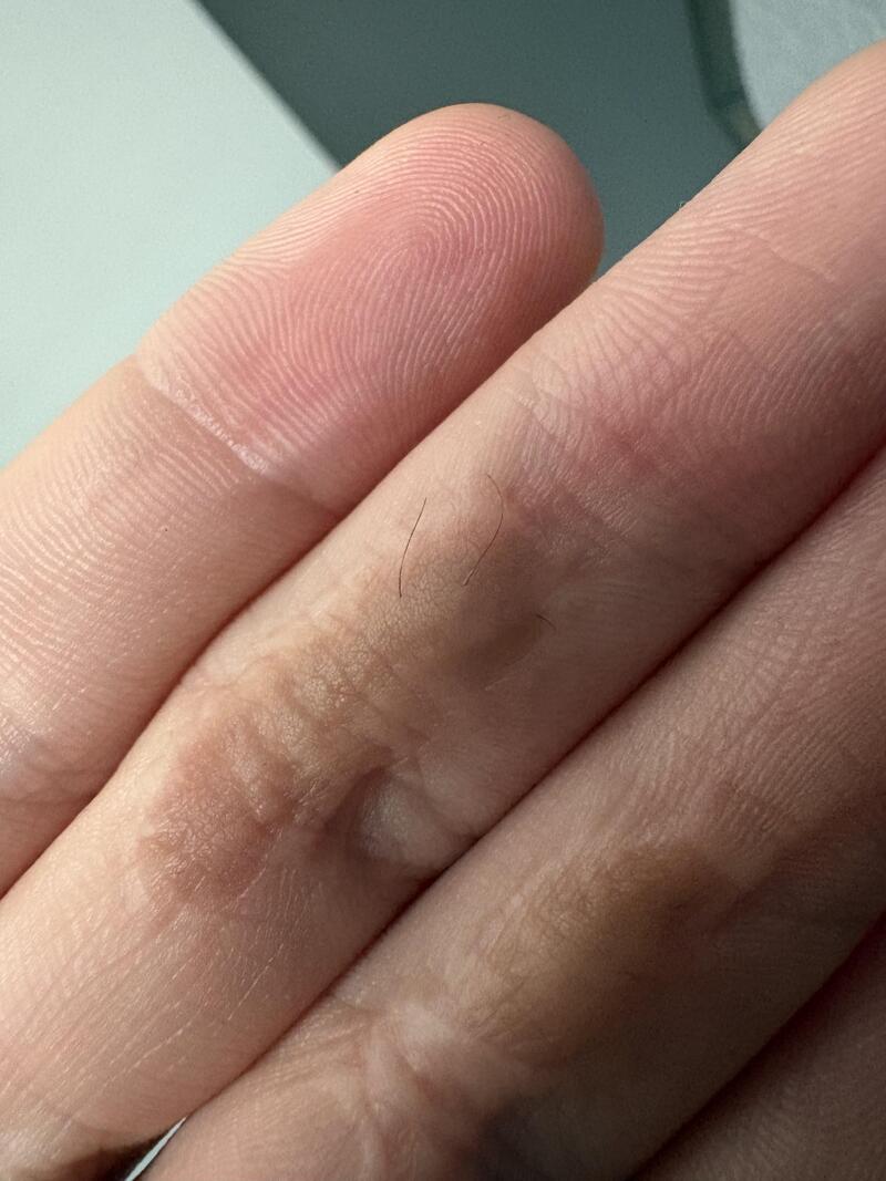 Close-up of a human finger with a small blister or bump.