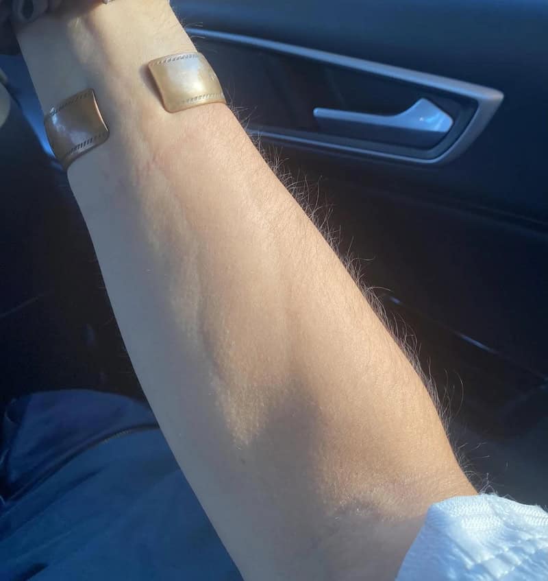 Close-up of a person's arm with a bandage on the elbow inside a car.