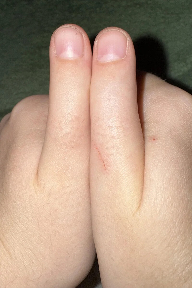 Two fingers with a small cut on the side, close-up view.