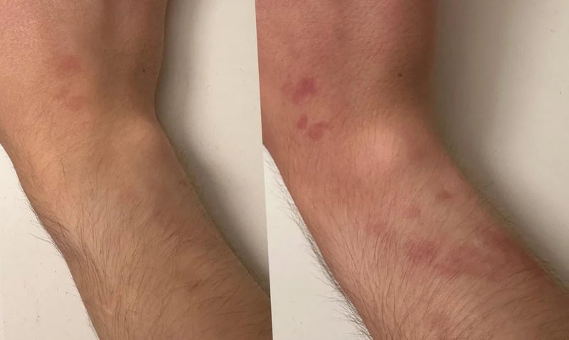 Comparison of skin with and without rash on arm.