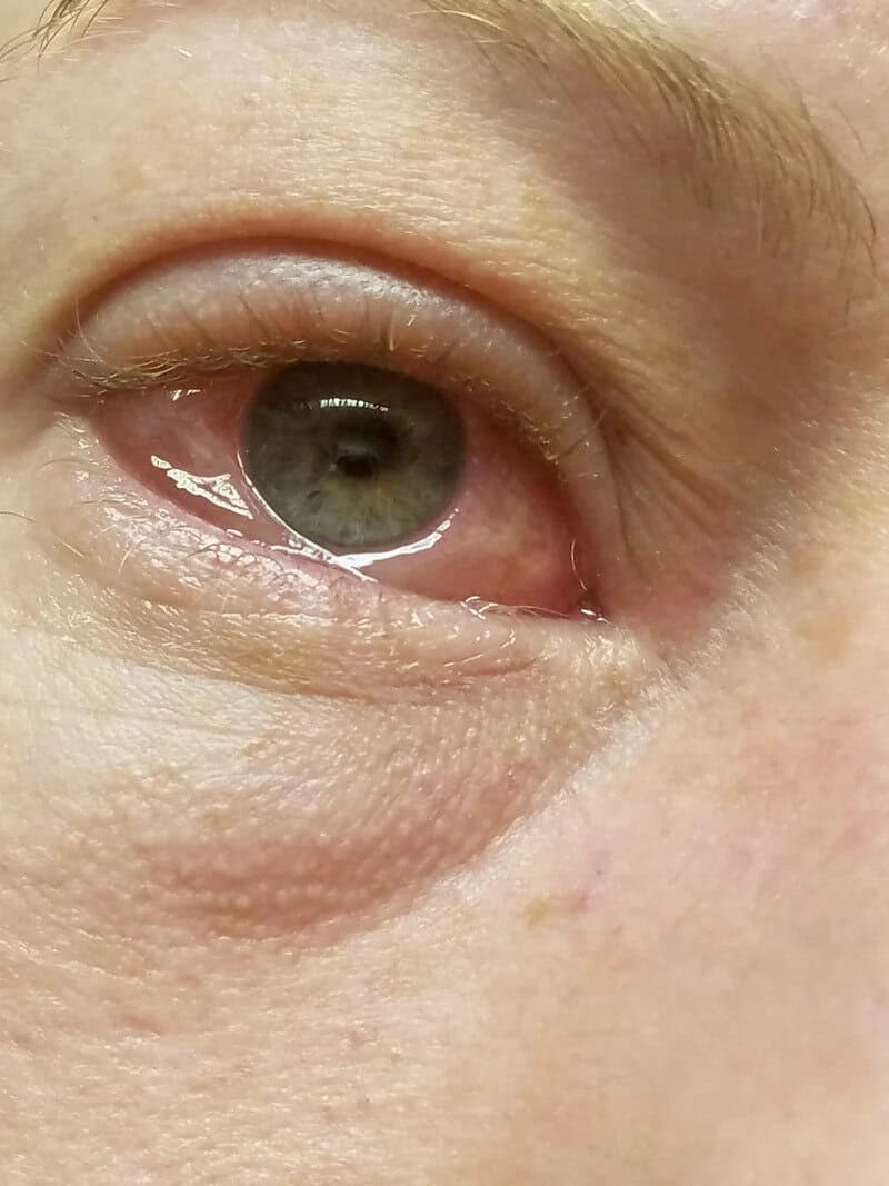 Close-up of a human eye with visible skin texture and eyelashes.