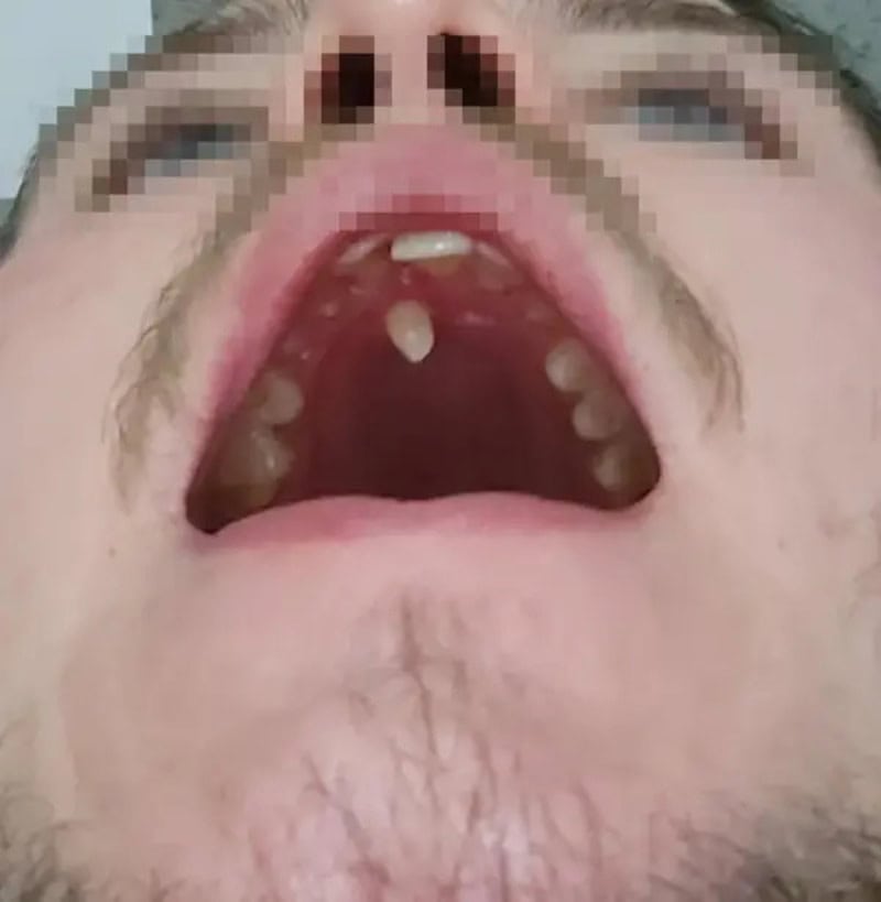 Close-up of a person's open mouth showing teeth and tongue.