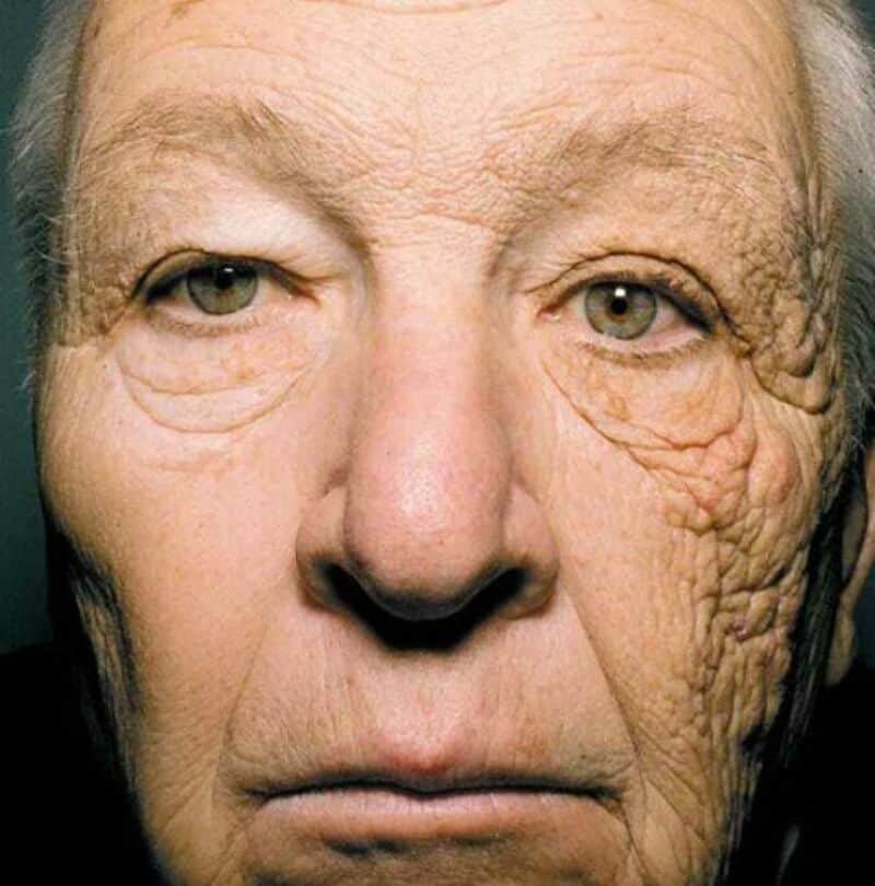 Close-up of an elderly person's face showing signs of aging and skin wrinkles.