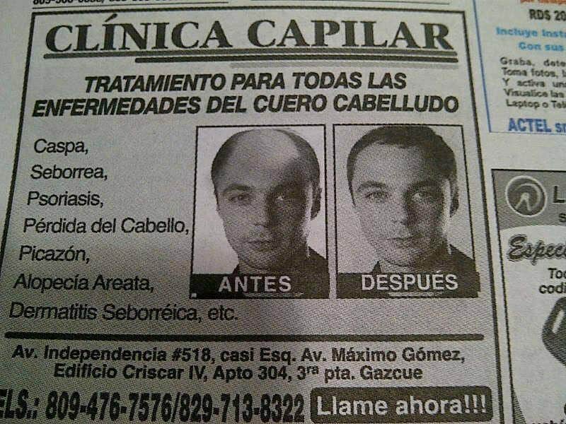 Before and after photos showing treatment for hair loss conditions like caspa, sebo.