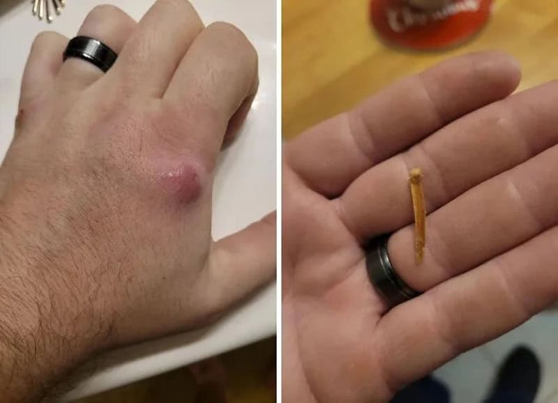 Close-up of a hand with a burn blister and a matchstick on the same hand.